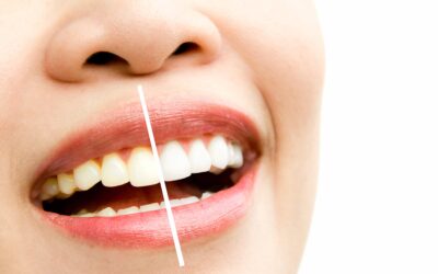 Obtén una sonrisa más brillante: Blanqueamiento dental en Propiodent Úbeda