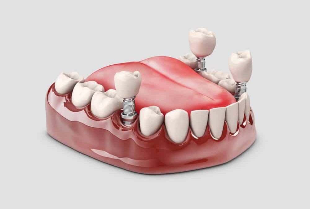 Implante dental propiodent