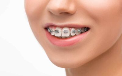 Ortodoncia: Todo lo que necesitas saber sobre tratamientos y costos