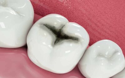 Todo lo que necesitas saber sobre el empaste dental: tipos procedimiento y cuidados