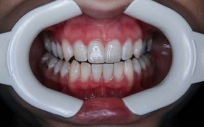 Todo sobre el blanqueamiento dental: qué es, ventajas y desventajas