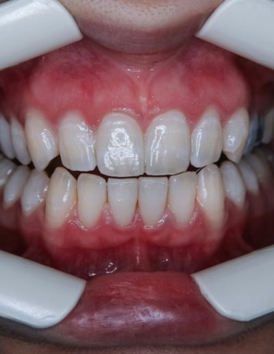 Dientes sometiéndose a procedimiento de blanqueamiento dental