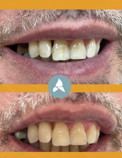 antes y después de tratamiento de blanqueamiento dental en Propiodent