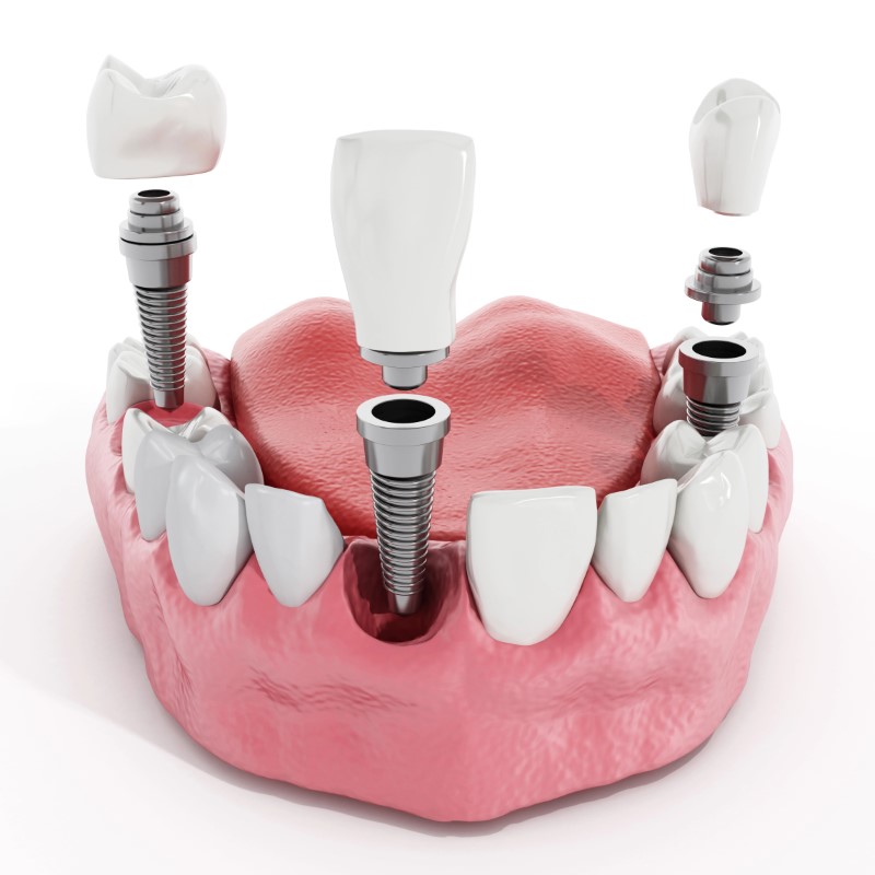 Imagen de dentadura con implantes dentales