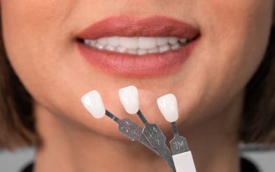 ¿Son lo mismo las fundas dentales que las carillas? ¿Cuál es mejor elección?