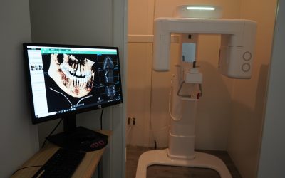 Implantes dentales en Úbeda: recupera tu sonrisa con seguridad